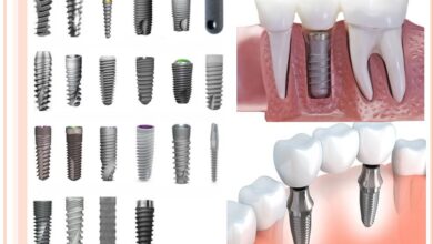 انواع برندهای ایمپلنت دندان کره ای، سوئیسی، آلمانی، آمریکایی چه