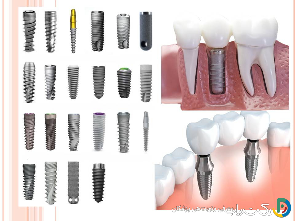 انواع برندهای ایمپلنت دندان کره ای، سوئیسی، آلمانی، آمریکایی چه