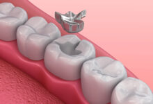 معایب ترمیم دندان چیست؟