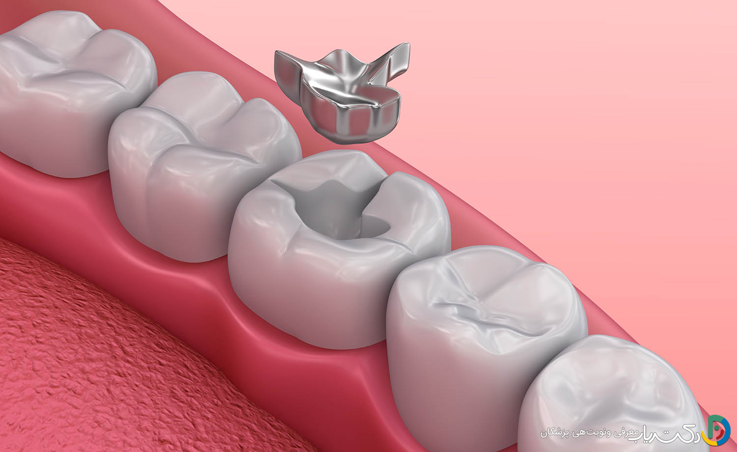 معایب ترمیم دندان چیست؟