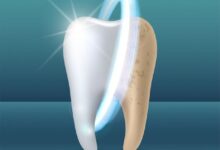 معایب بلیچینگ دندان چیست؟راهنمای جامع برای سفید کردن ایمن دندانها