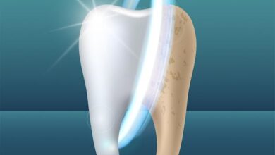 معایب بلیچینگ دندان چیست؟راهنمای جامع برای سفید کردن ایمن دندانها