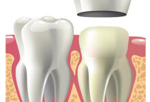چه مراحلی برای نصب روکش دندان انجام می شود؟