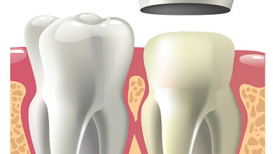 چه مراحلی برای نصب روکش دندان انجام می شود؟