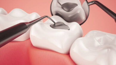 انواع مواد برای پر کردن دندان کدامند؟