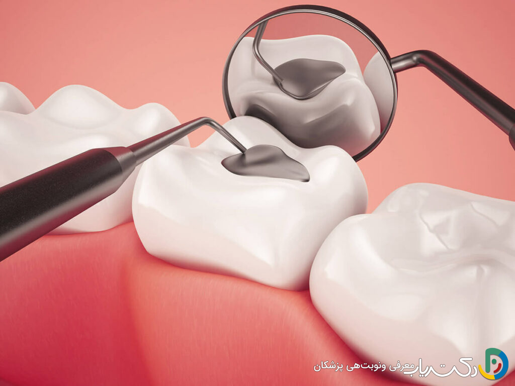 انواع مواد برای پر کردن دندان کدامند؟