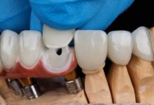 چه عواملی بر طول عمر روکش دندان تأثیر می گذارند؟