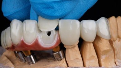 چه عواملی بر طول عمر روکش دندان تأثیر می گذارند؟