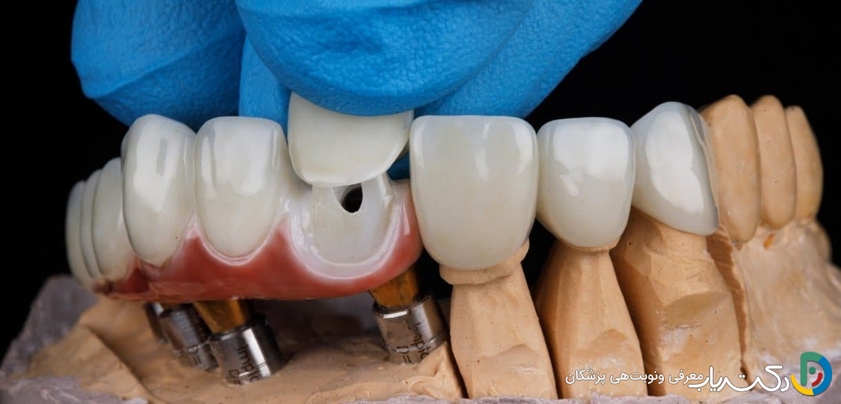 چه عواملی بر طول عمر روکش دندان تأثیر می گذارند؟