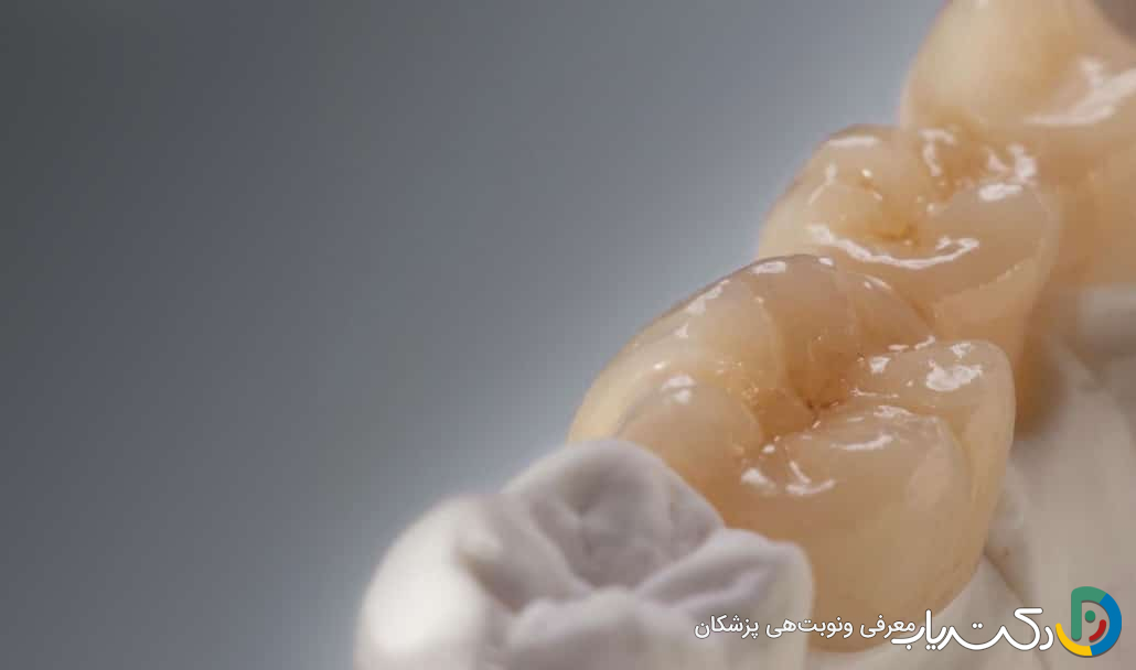 چه عواملی بر طول عمر ترمیم دندان تأثیر می گذارند؟