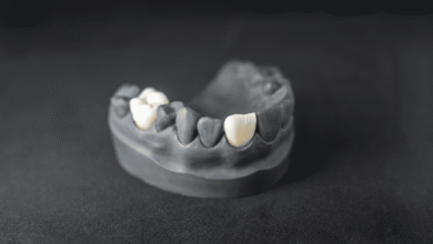 چه عواملی بر قیمت روکش دندان تأثیر می گذارند؟