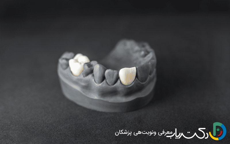 چه عواملی بر قیمت روکش دندان تأثیر می گذارند؟