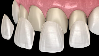 چه عواملی بر قیمت ترمیم دندان تأثیر می گذارند؟