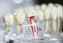 چه عواملی بر قیمت عصب کشی دندان تأثیر می گذارند؟