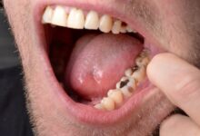 چه عواملی باعث خراب شدن ترمیم دندان می شود؟