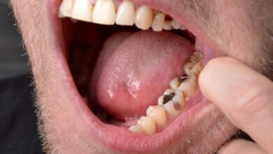 چه عواملی باعث خراب شدن ترمیم دندان می شود؟