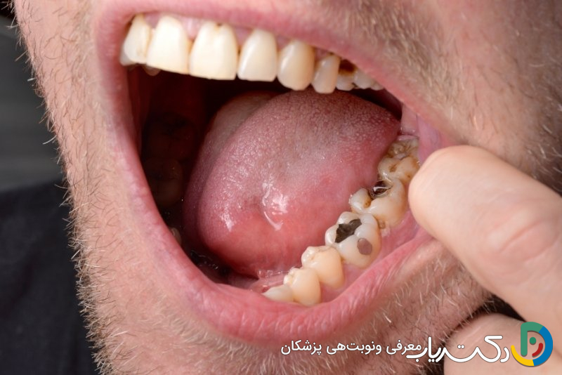 چه عواملی باعث خراب شدن ترمیم دندان می شود؟