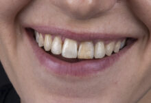 چه عواملی باعث تغییر رنگ دندان ها می شود؟