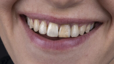 چه عواملی باعث تغییر رنگ دندان ها می شود؟