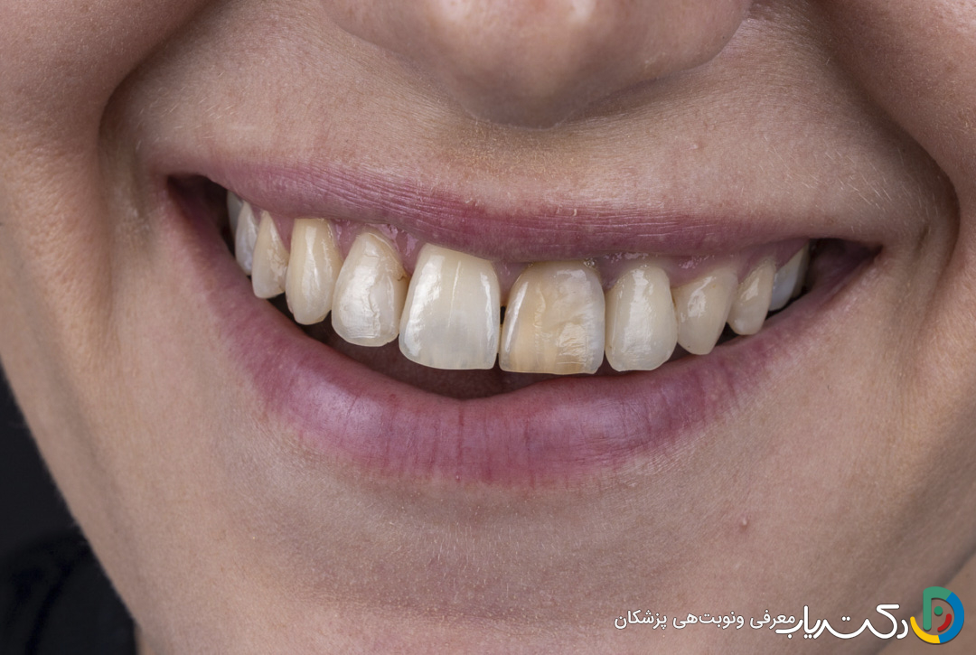 چه عواملی باعث تغییر رنگ دندان ها می شود؟