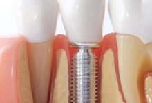 عمر ایمپلنت دندان به چه عواملی بستگی دارد ؟