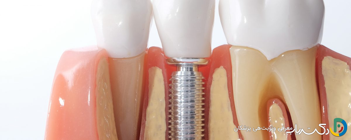 عمر ایمپلنت دندان به چه عواملی بستگی دارد ؟