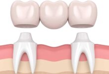 بریج دندان چیست ؟ مزایا و معایت آن