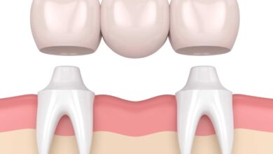 بریج دندان چیست ؟ مزایا و معایت آن