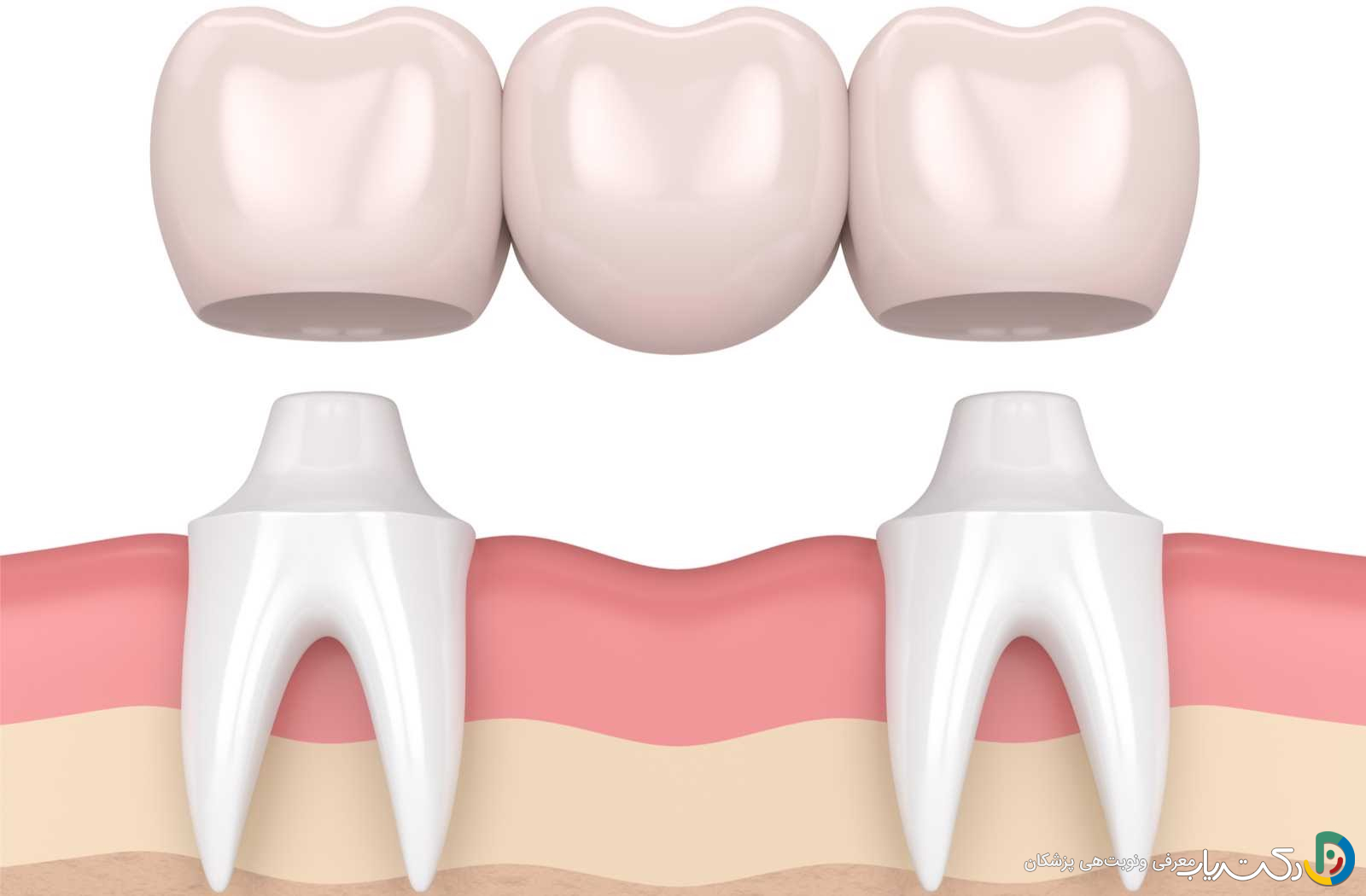 بریج دندان چیست ؟ مزایا و معایت آن