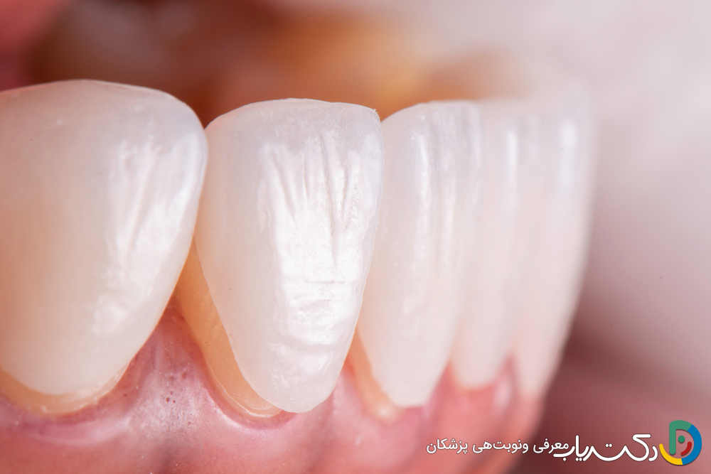لمینت بدون تراش چیست ؟ (مزایا و معایت آن)