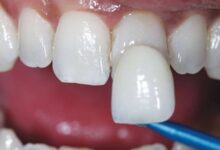 لمینت دندان خرگوشی چیست ؟