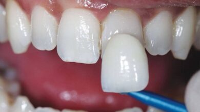 لمینت دندان خرگوشی چیست ؟