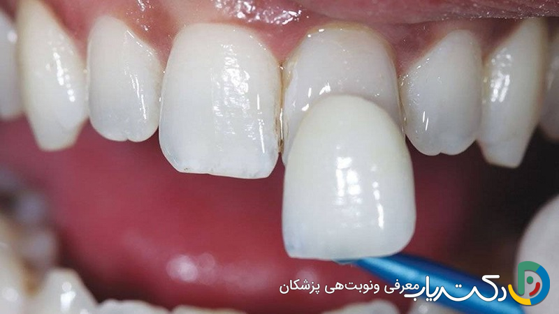 لمینت دندان خرگوشی چیست ؟