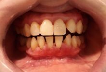 ارتباط تحلیل لثه و دندان مصنوعی چیست ؟