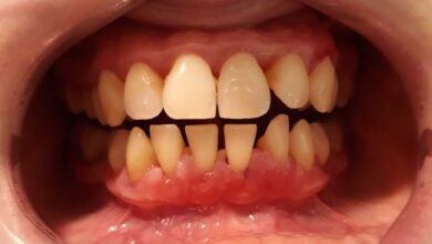 ارتباط تحلیل لثه و دندان مصنوعی چیست ؟