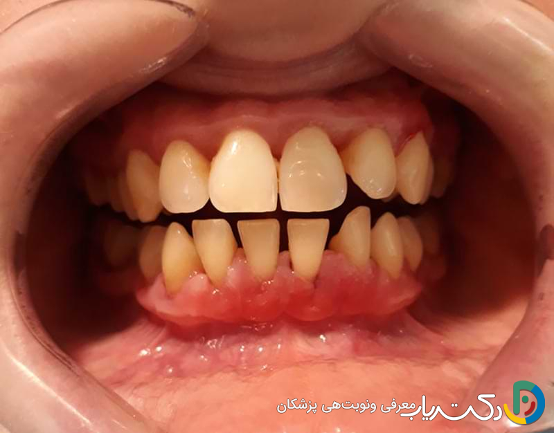 ارتباط تحلیل لثه و دندان مصنوعی چیست ؟