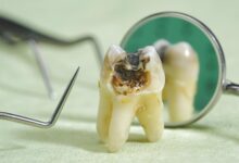 پوسیدگی دندان چیست و چگونه می توان از آن پیشگیری کرد ؟