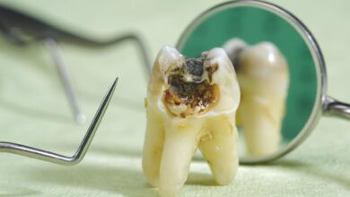 پوسیدگی دندان چیست و چگونه می توان از آن پیشگیری کرد ؟
