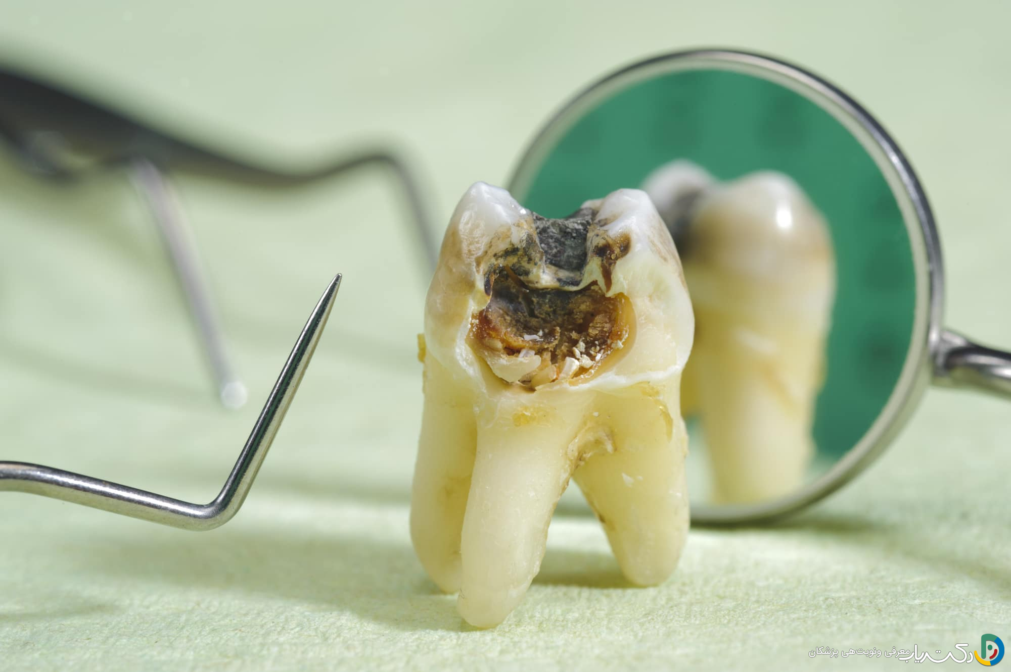 پوسیدگی دندان چیست و چگونه می توان از آن پیشگیری کرد ؟