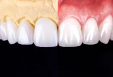 چه مشکلاتی ممکن است پس از انجام کامپوزیت دندان پیش آید؟
