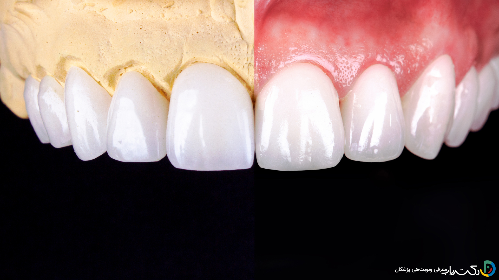 چه مشکلاتی ممکن است پس از انجام کامپوزیت دندان پیش آید؟