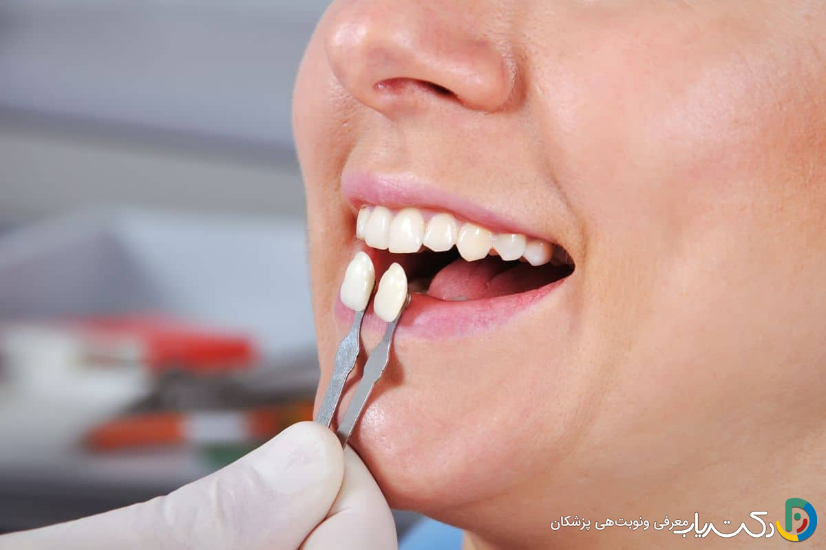 چه مشکلاتی ممکن است پس از نصب روکش دندان پیش آید؟