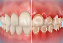 چه مشکلاتی ممکن است بعد از ارتودنسی ایجاد شود؟