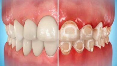 چه مشکلاتی ممکن است بعد از ارتودنسی ایجاد شود؟