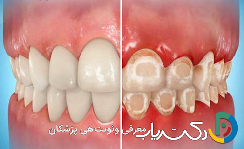 چه مشکلاتی ممکن است بعد از ارتودنسی ایجاد شود؟