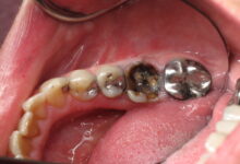 چه مشکلاتی ممکن است پس از عصب کشی دندان ایجاد شود؟