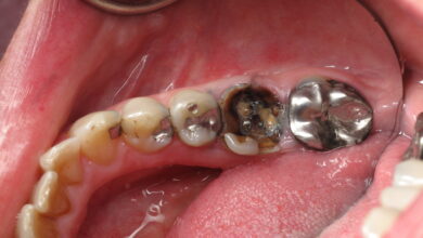 چه مشکلاتی ممکن است پس از عصب کشی دندان ایجاد شود؟