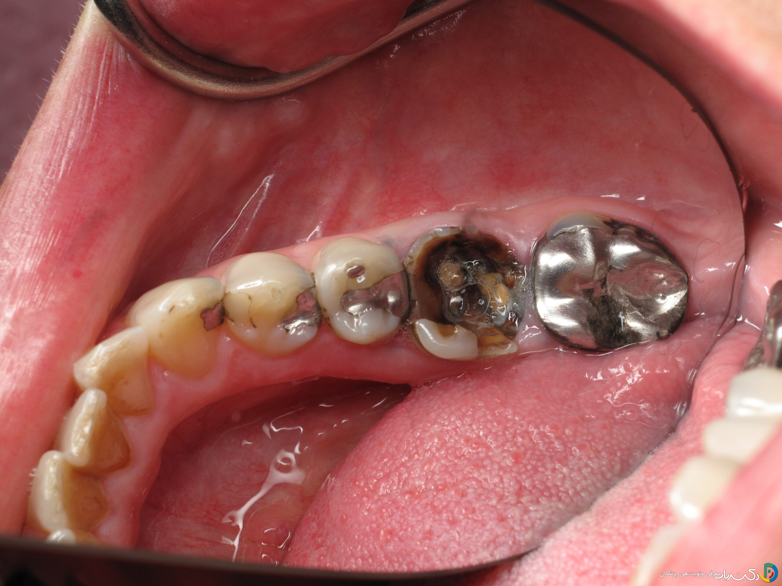 چه مشکلاتی ممکن است پس از عصب کشی دندان ایجاد شود؟