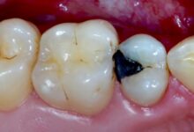 چه مشکلاتی ممکن است پس از ترمیم دندان پیش آید؟