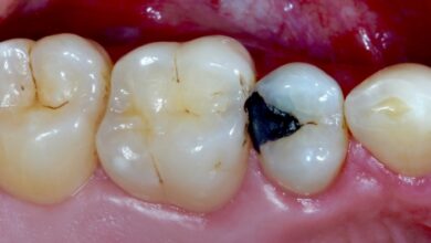 چه مشکلاتی ممکن است پس از ترمیم دندان پیش آید؟